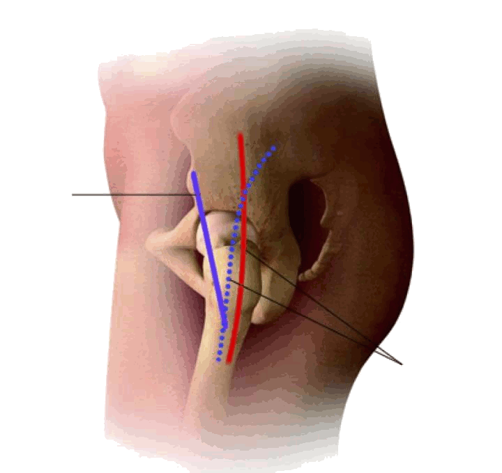 Approach Incisions.gif