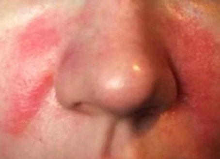 MISIJA ĮMANOMA - ATOPINIS DERMATITAS