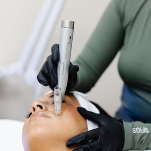 Why Regular Microneedling Is One of the Best Investments You Can Make for Your Skin