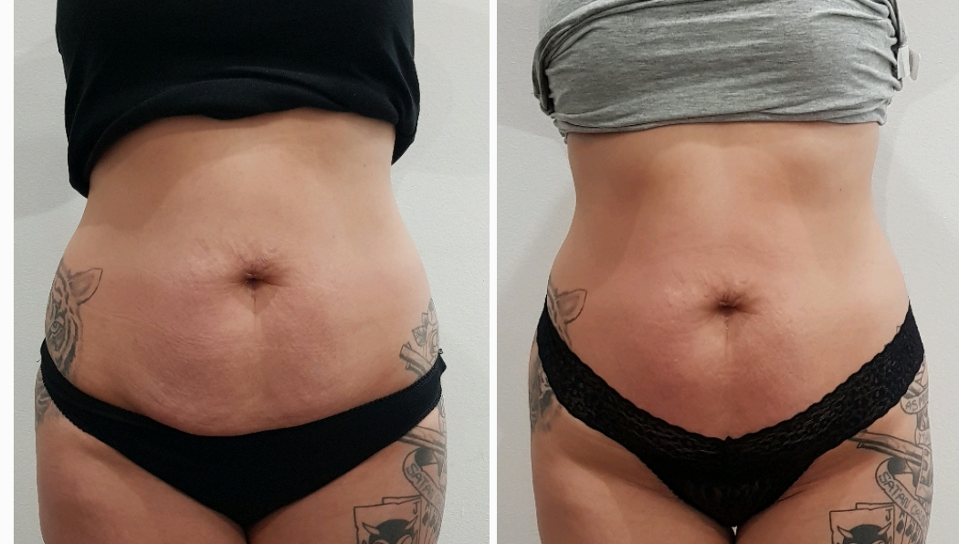 Lipofirm Pro Sharon Cameron Advanced Therapist Lipofirm Pro Sharon Cameron Advanced Therapist