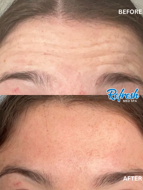 Xeomin Refresh Med Spa Lincoln Nebraska
