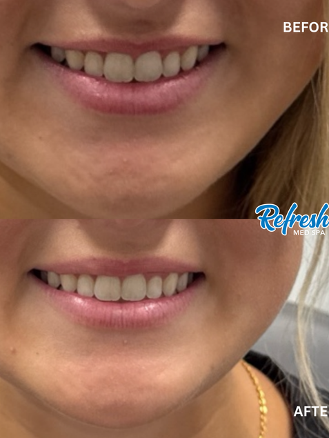 Lip Flip Lincoln Nebraska Refresh Med Spa