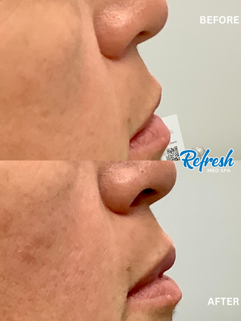 Lip Flip Refresh Med Spa Lincoln Nebraska