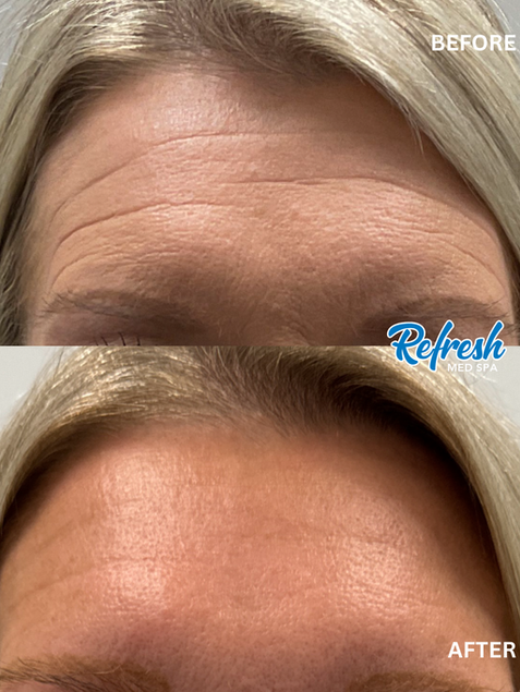 Forehead Botox Refresh Med Spa Lincoln Nebraska