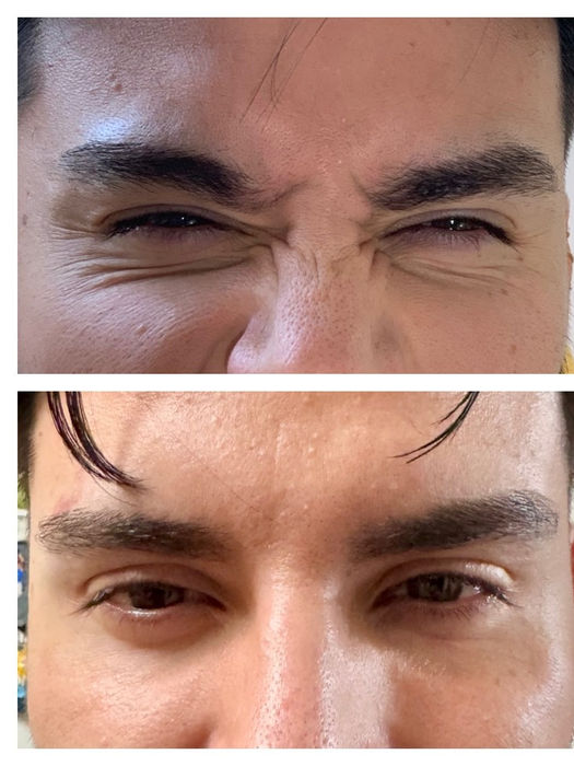 man before and after frown botox