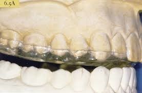 Placa Estabilizadora em Articulador para verificar contatos defectivos