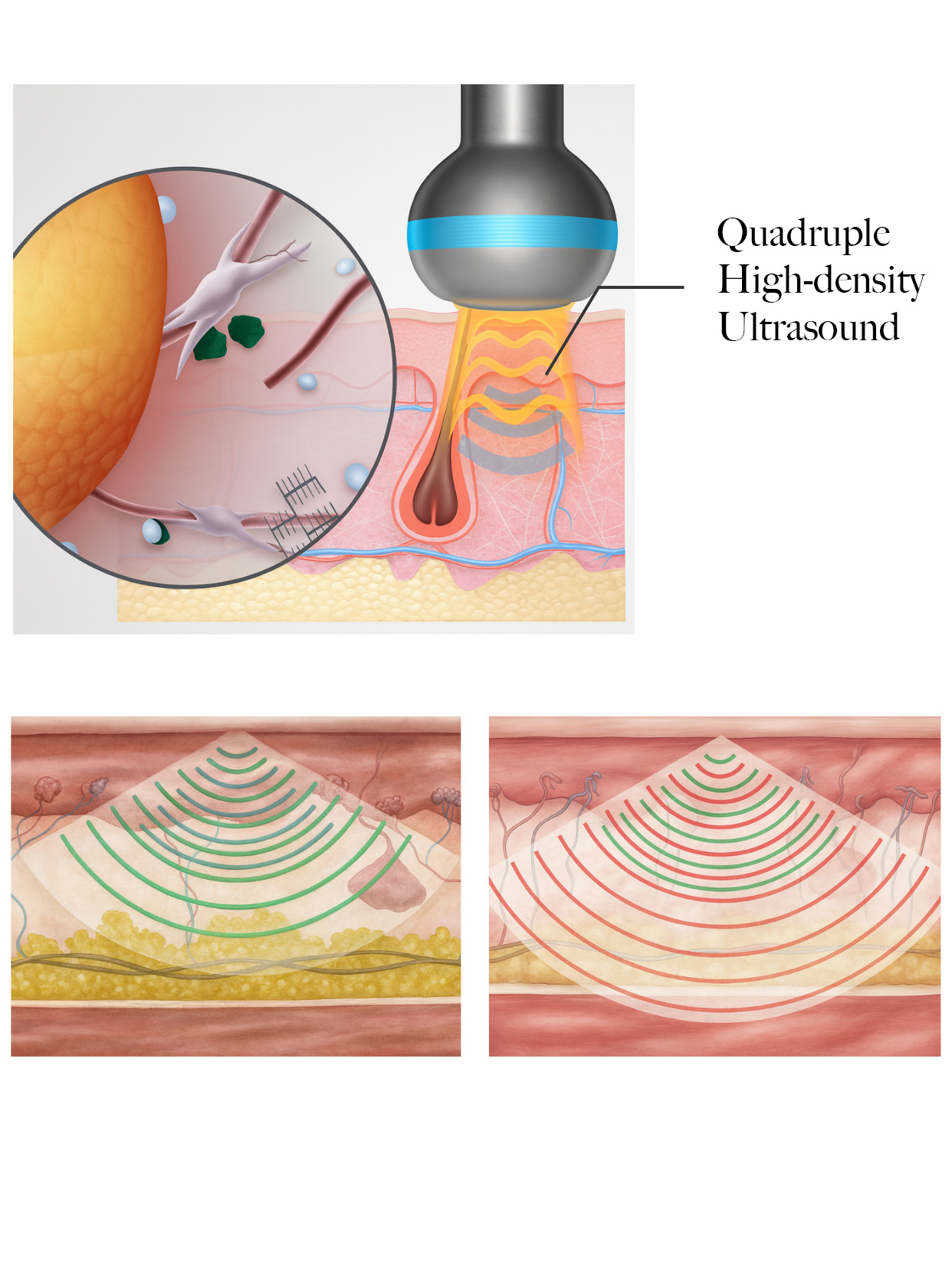 Advanced LDM ultrasound and plasma technology used to improve skin texture, glow, and firmness