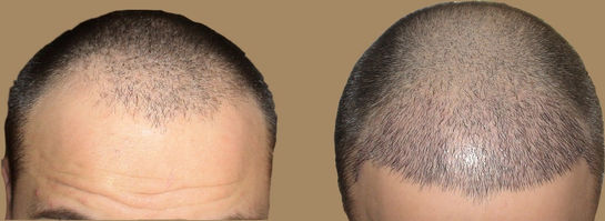 Hair Transplant in Turkey Before and After