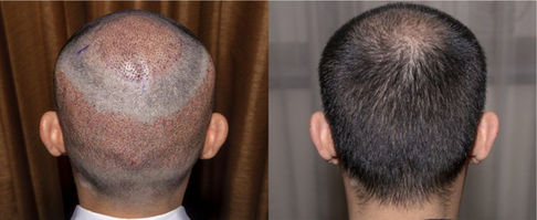 Hair Transplant in Turkey Before and After