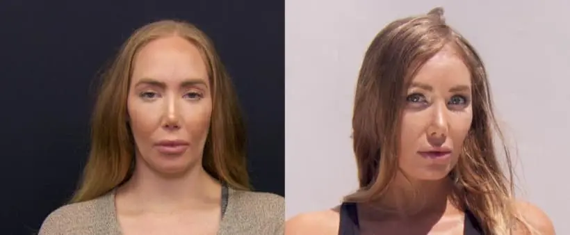 forehead reduction results