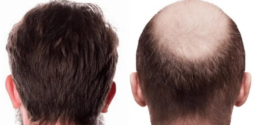 TURKEY BEST CLINICS FOR HAIR TRANSPLANT