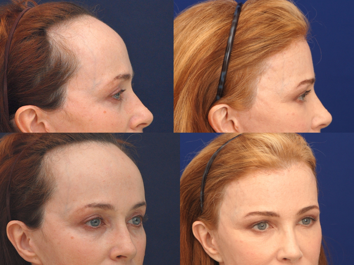 forehead reduction before and after