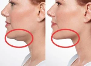 Jaw Lift Operation in Turkey Before and After