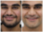 Full Mouth Rehabilitation