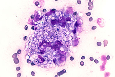 Fungal infection of lung, histoplasmosis_ Fine needle aspirate (FNA) of a pulmonary nodul