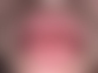 Hårde læber efter filler