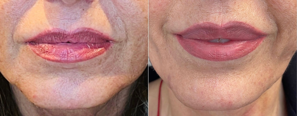 Botox Lipflip Dr.Per