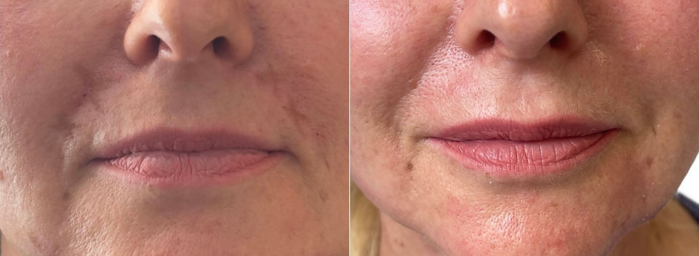 Botox Lipflip Dr.Per