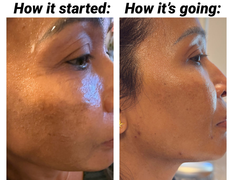Før og efter billeder af melasma behandling med synlig reduktion af pigmentering