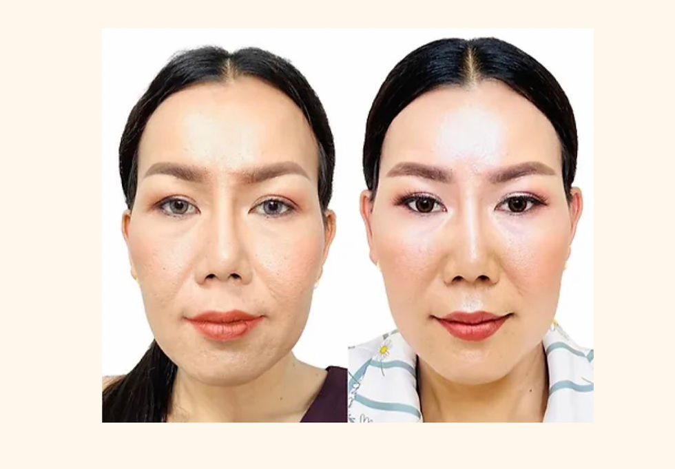 Botox Lipflip Dr.Per