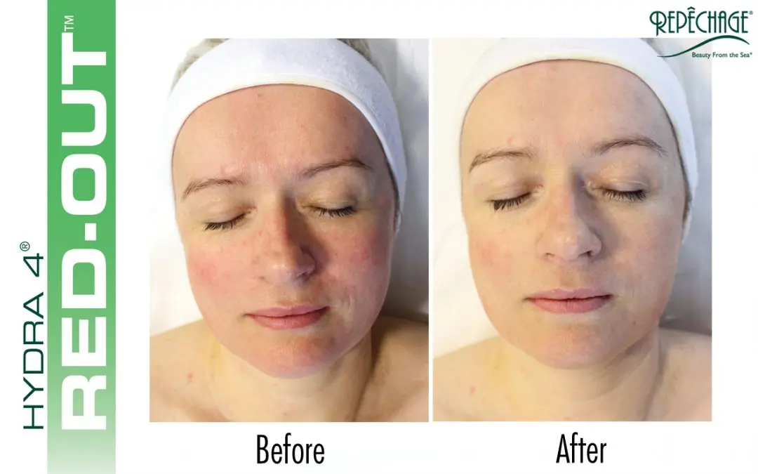 redoutbeforeafter-copy-1080x675.webp