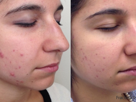IM_Fractora_2a_iso_LS_24coated_20mj_Acne