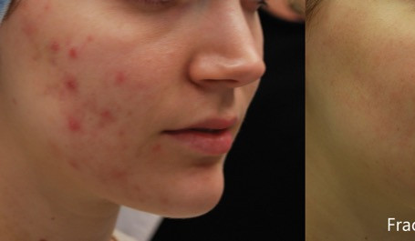 JH_Fractora_3f_4tx_RS_1month_Acne_24pin_