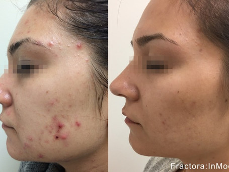 IM_Fractora_4a_2TX_Acne_IR.jpeg