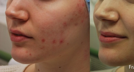 JH_Fractora_3e_4tx_LS_1month_Acne_24pin_