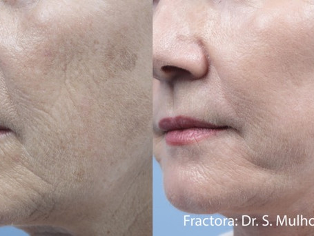 SM_Fractora_2c_60mJ_6months_ISOLS.jpeg