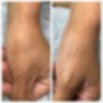 Scar Correction on hand Before and After