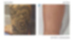 Before/After Laser Tattoo Removal