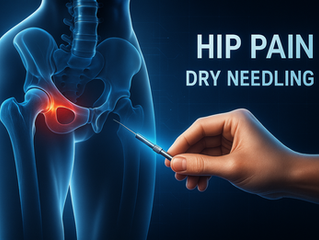 Illustration showing dry needling treatment for hip pain and labral tear at Empower Rehab & Wellness in Buckhead Atlanta.