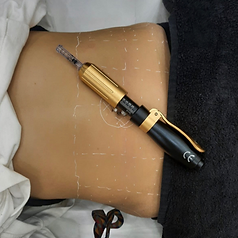 Mesotherapy.png