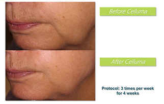 how-to-get-rid-of-turkey-neck-serenity-salt-spa