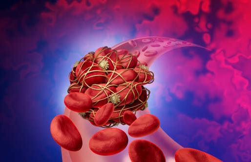 Coágulos sanguíneos