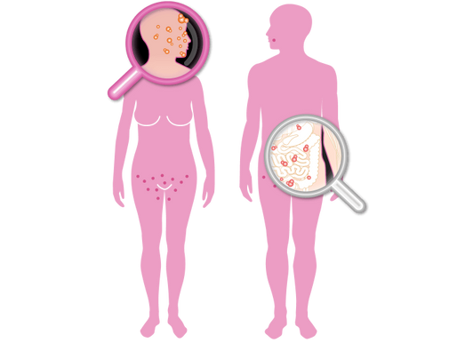 Enfermedades de transmisión sexual (ETS)