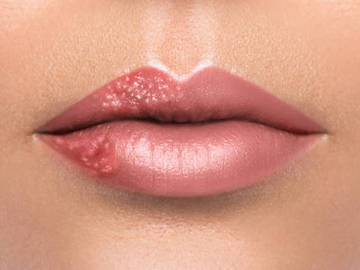 Herpes labial