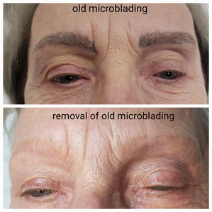 Permanent Makeup Removal