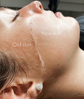 dermaplne.png