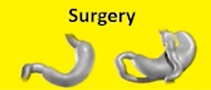 Bariatric Surgery