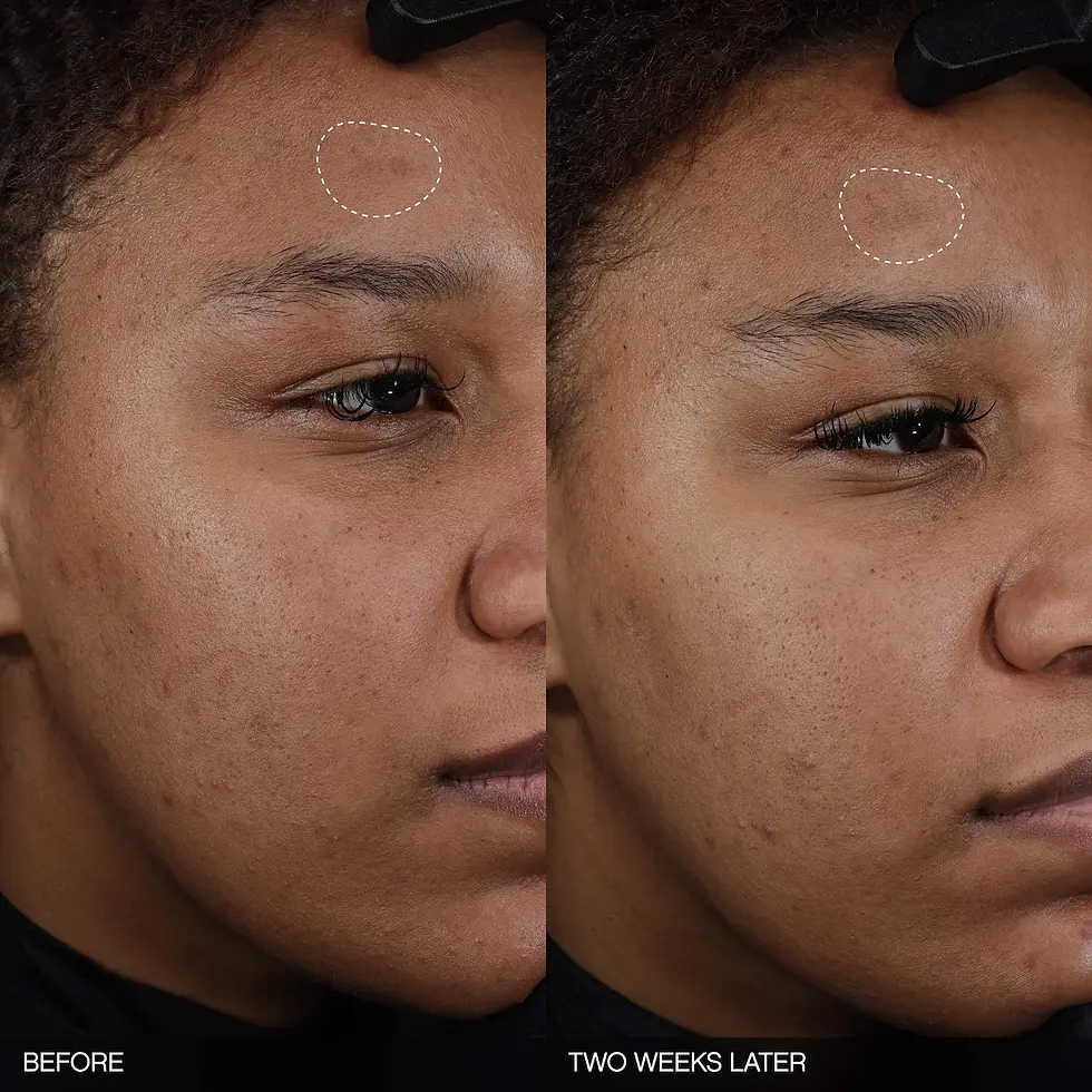 Miniatura: Faded Tranexamic Acid Dark Spot Patches para Hiperpigmentación