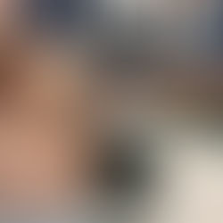 Bicep Rupture Hemorrhage