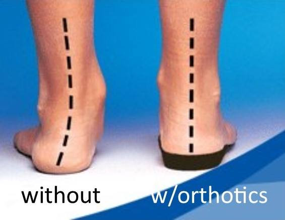 wwo orthotics.jpg