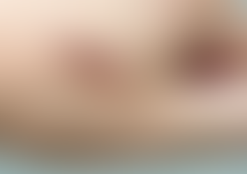 How Keloid Treatment Is Used for Raised Scars
