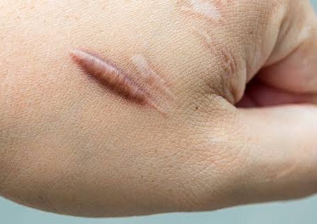 How Keloid Treatment Is Used for Raised Scars