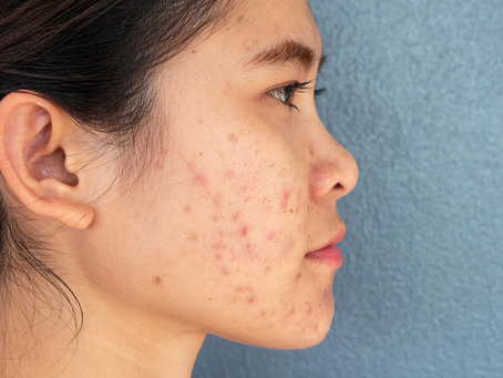 Does Acne Scar Treatment Work on Deep Scarring?