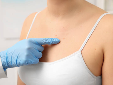 What Determines the Best Approach to Birthmark Removal?