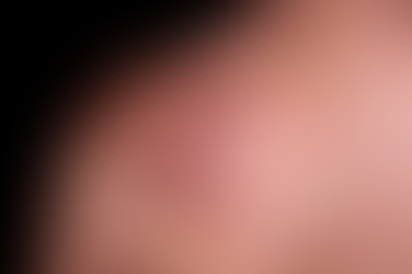 How Keloid Treatment Helps Improve Skin Appearance?