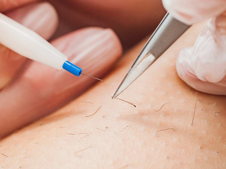 Can Electrolysis Laser Hair Removal Help With Ingrown Hairs?